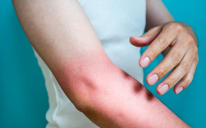 Sunburnt arm